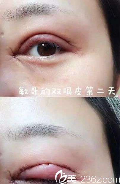 雙眼皮和開眼角手術(shù)第2天恢復(fù)照 雙眼皮和開眼角手術(shù)第2天恢復(fù)照