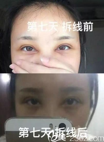 <!--<i data=20240703-sp></i>-->雙眼皮開眼角7天拆線照片 <!--<i data=20240703-sp></i>-->雙眼皮開眼角7天拆線照片