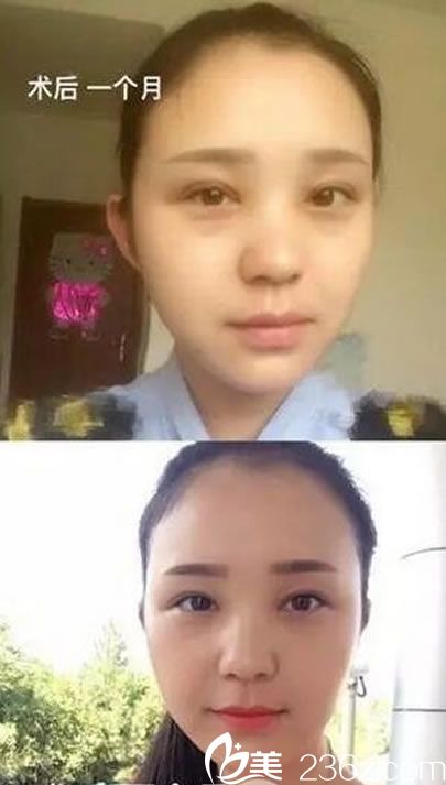 做雙眼皮和開眼角術(shù)后1-2個月恢復(fù)照 做雙眼皮和開眼角術(shù)后1-2個月恢復(fù)照