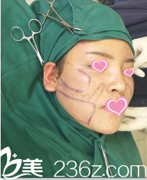 準(zhǔn)備面部吸脂時(shí)的照片 準(zhǔn)備面部吸脂時(shí)的照片