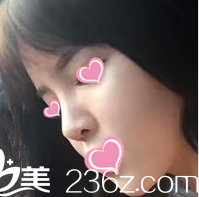 術(shù)后一個(gè)月的樣子 術(shù)后一個(gè)月的樣子