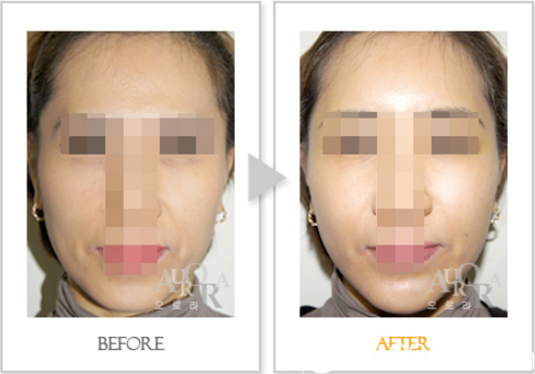 面部脂肪填充前后效果對(duì)比 面部脂肪填充前后效果對(duì)比