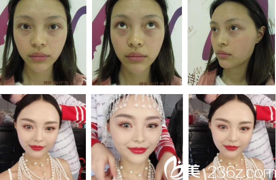 西安高一生醫(yī)療美容醫(yī)院劉軍術(shù)前照片1