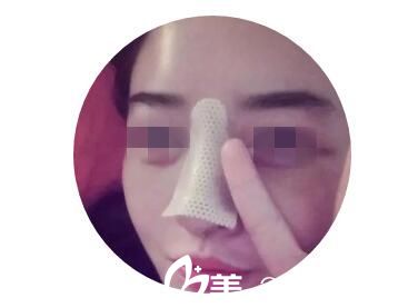 術(shù)后5天效果 術(shù)后5天效果