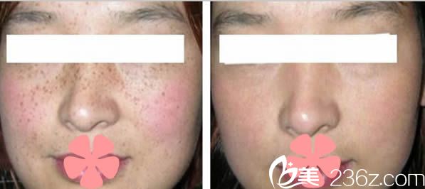 駱巧陽激光祛斑前后對比效果