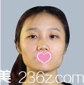 北京美萊醫(yī)療美容醫(yī)院案例術(shù)前照 北京美萊醫(yī)療美容醫(yī)院案例術(shù)前照