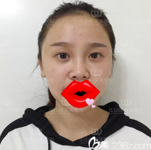 在連天美做雙眼皮手術(shù)前 在連天美做雙眼皮手術(shù)前