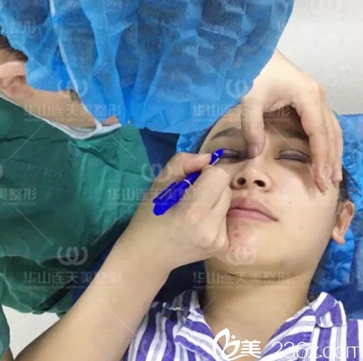杭州連天美姜鑫利設(shè)計雙眼皮方案 杭州連天美姜鑫利設(shè)計雙眼皮方案