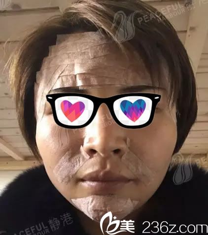 做完自體脂肪填充即刻效果 做完自體脂肪填充即刻效果