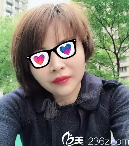 原本憔悴又顯老的我找寧波靜港整形程衛(wèi)民院長做了自體脂肪全臉填充后秒變少女臉