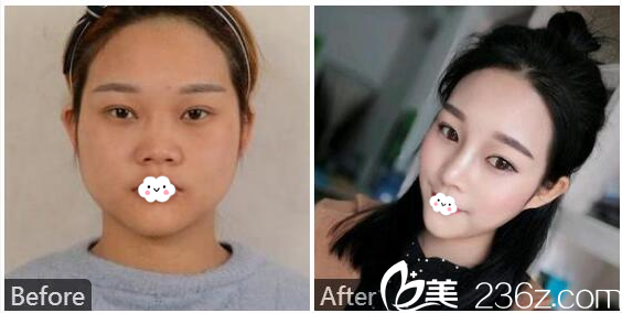 趙晟弼做的鼻部鼻綜合隆鼻案例 趙晟弼做的鼻部鼻綜合隆鼻案例