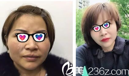 自體脂肪填充全臉10天前后對比照 自體脂肪填充全臉10天前后對比照