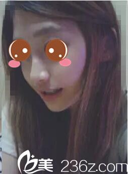 韓國(guó)AJ李秉烈為我做的顴骨整形+下巴縮小，一掃之前的老氣橫秋