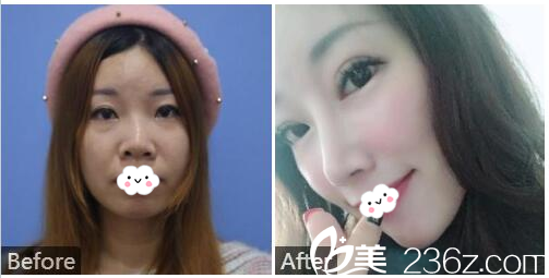 廣州紫馨金孝憲做的鼻綜合隆鼻案例