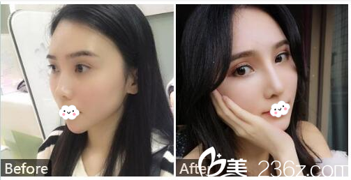 廣州紫馨2019新年優(yōu)惠整形價格表 李政祐雙眼皮4800元,姬付康隆鼻8800元附案例