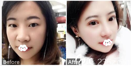 廣州紫馨金孝憲做的雙眼皮和隆鼻案例 廣州紫馨金孝憲做的雙眼皮和隆鼻案例