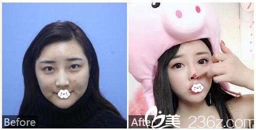 廣州紫馨李政祐做的雙眼皮案例 廣州紫馨李政祐做的雙眼皮案例