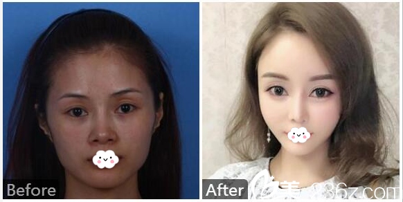 廣州紫馨金孝憲做鼻子案例圖片