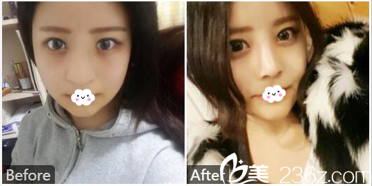 廣州天姿單永鵬隆鼻案例