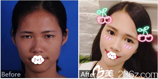 廣州天姿單永鵬面部埋線提升案例