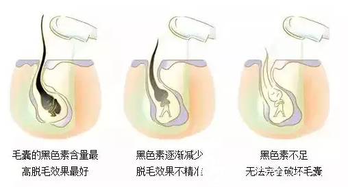 冰點(diǎn)脫毛原理示意圖