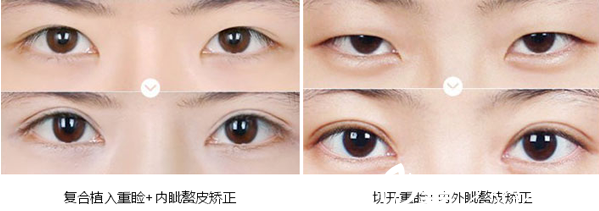 內(nèi)江達(dá)芬奇整形雙眼皮術(shù)后效果對(duì)比照 內(nèi)江達(dá)芬奇整形雙眼皮術(shù)后效果對(duì)比照