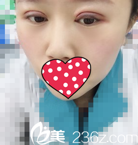 雙眼皮術(shù)后3天照 雙眼皮術(shù)后3天照