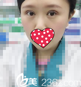 雙眼皮一周拆線 雙眼皮一周拆線