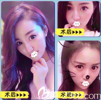 佛山華美陽海斌面部脂肪填充案例 佛山華美陽海斌面部脂肪填充案例