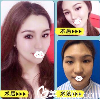 佛山華美陽海斌所隆鼻案例 佛山華美陽海斌所隆鼻案例