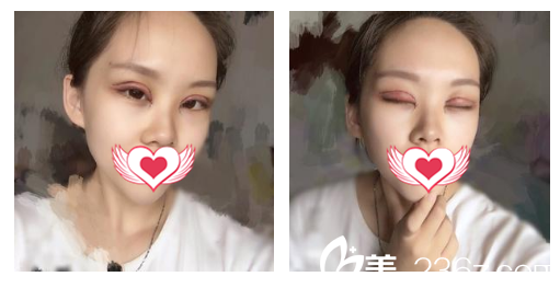 在安慶維多利亞整形做眼綜合術(shù)后第1天恢復(fù)情況 在安慶維多利亞整形做眼綜合術(shù)后第1天恢復(fù)情況