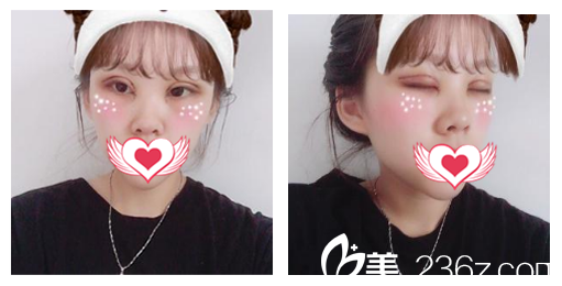 安慶維多利亞整形端木義勇割雙眼皮+開內(nèi)眼角+眼部脂肪去除眼綜合術(shù)后第3天恢復(fù)效果 安慶維多利亞整形端木義勇割雙眼皮+開內(nèi)眼角+眼部脂肪去除眼綜合術(shù)后第3天恢復(fù)效果