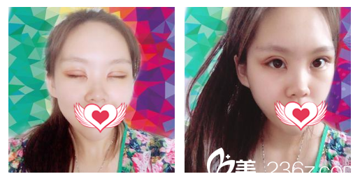 找安慶維多利端木義勇做眼綜合整形術(shù)后第7天拆線后照片 找安慶維多利端木義勇做眼綜合整形術(shù)后第7天拆線后照片