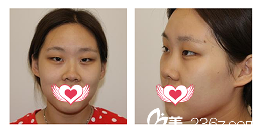 沒有去安慶維多利亞整形做全切雙眼皮+開內(nèi)眼角+上眼瞼脂肪取出眼綜合整形前的樣子 沒有去安慶維多利亞整形做全切雙眼皮+開內(nèi)眼角+上眼瞼脂肪取出眼綜合整形前的樣子