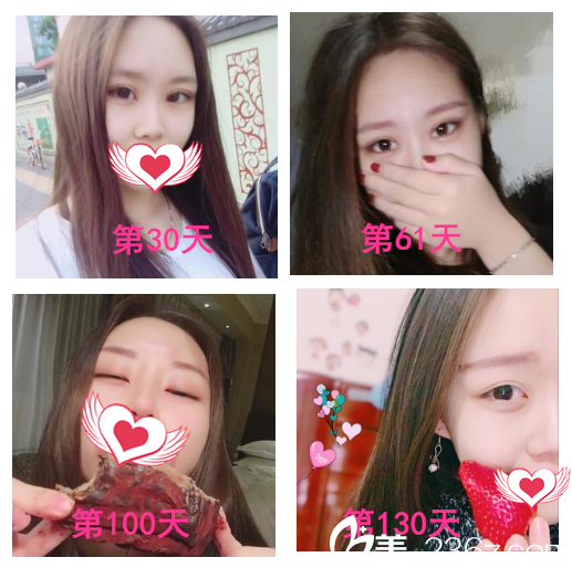 在安慶維多利亞做眼綜合整形4個(gè)月了 小花們看看我的眼睛漂亮嗎