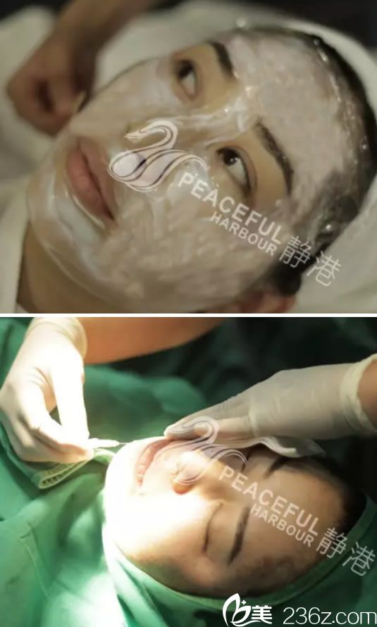 寧波靜港面部線雕手術(shù)過(guò)程圖