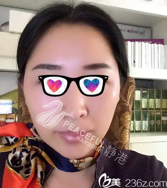 40歲的本人在寧波靜港做全臉埋線提拉經(jīng)歷 植入120根蛋白線換來年輕十歲