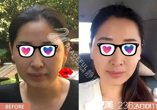 寧波靜港程衛(wèi)民面部線雕案例對(duì)比圖