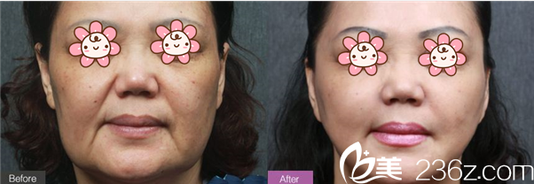 汪國(guó)應(yīng)埋線提升案例 汪國(guó)應(yīng)埋線提升案例