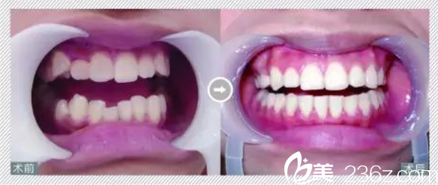 羅倩云牙齒矯正 羅倩云牙齒矯正