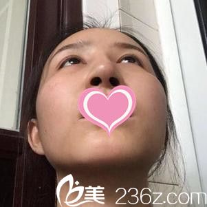 九江瑞麗醫(yī)療美容醫(yī)院萬成隆鼻手術(shù)案例 九江瑞麗醫(yī)療美容醫(yī)院萬成隆鼻手術(shù)案例