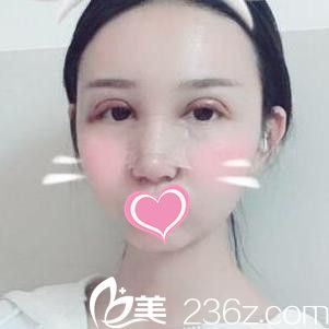 術(shù)后3天 術(shù)后3天