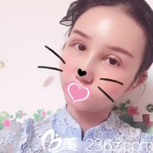 九江瑞麗萬成給我做的雙眼皮+隆鼻，明天就要拆線了