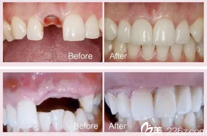 貴州利美康牙齒種植案例 貴州利美康牙齒種植案例