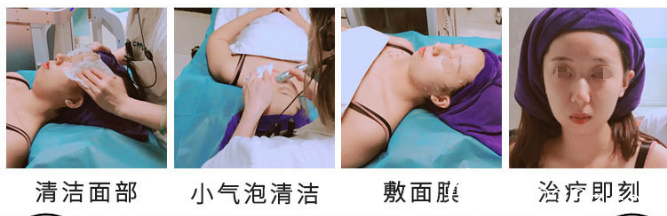 在無(wú)錫同舟整形做韓國(guó)小氣泡 在無(wú)錫同舟整形做韓國(guó)小氣泡