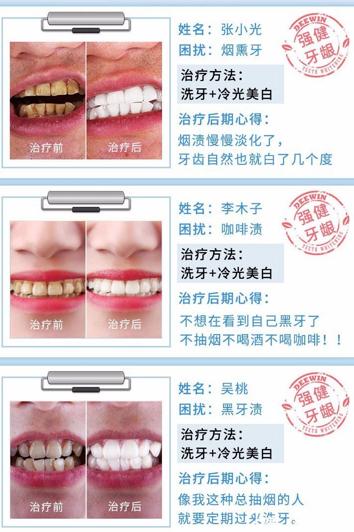 無(wú)錫同舟牙齒美白案例 無(wú)錫同舟牙齒美白案例