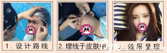 在無(wú)錫同舟做雙眼皮案例