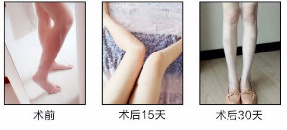 瘦臉除皺瘦小腿案例
