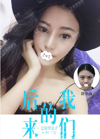 深圳麗港麗格整形醫(yī)院謝俊鼻綜合隆鼻案例 深圳麗港麗格整形醫(yī)院謝俊鼻綜合隆鼻案例