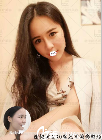 深圳麗港麗格整形醫(yī)院謝俊耳軟骨隆鼻案例圖 深圳麗港麗格整形醫(yī)院謝俊耳軟骨隆鼻案例圖